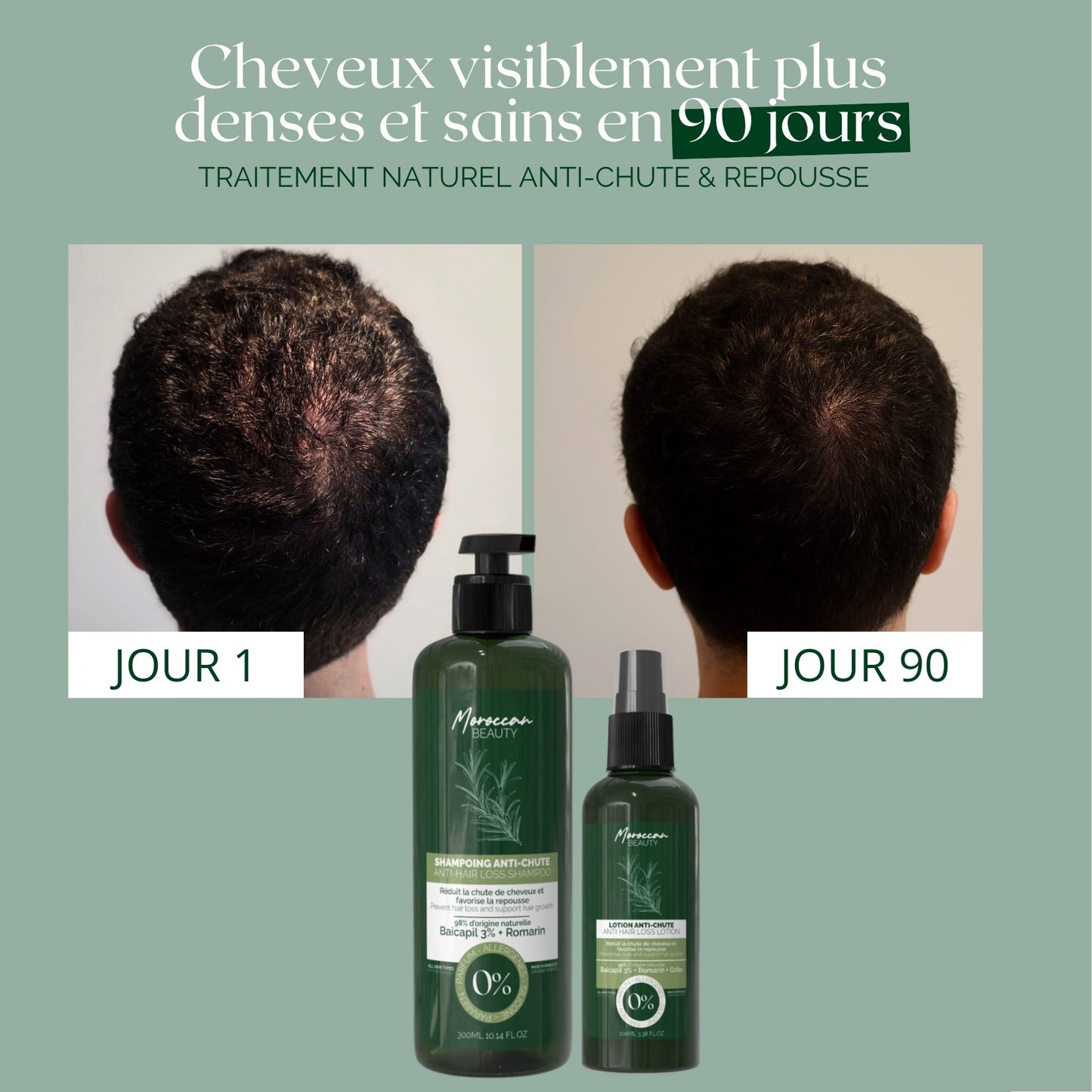 Natural Anti-Hair Loss & Regrowth Duo – Shampoo 300ml & Lotion 100ml – 90-Day Treatment